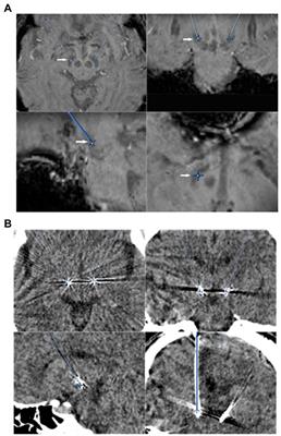 The efficacy and safety of asleep and awake subthalamic deep brain stimulation for Parkinson’s disease patients: A 1-year follow-up